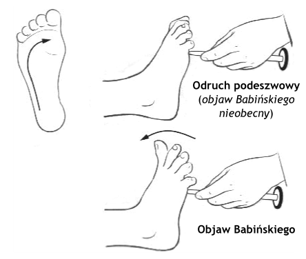 Objaw Babińskiego – co oznacza? Kiedy jest&nbsp;nieprawidłowy?