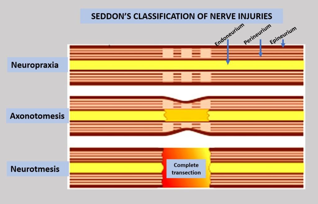 Stopnie uszkodzenia nerwów